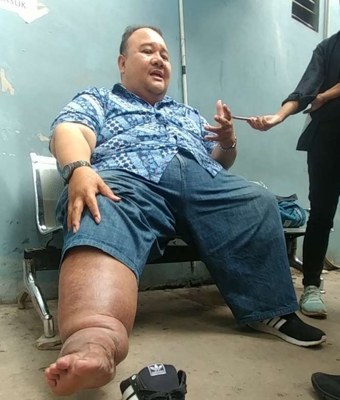 6 Potret Kondisi Terakhir Rony Dozer Sebelum Meninggal Dunia, Pernah Ngaku Kena Santet!