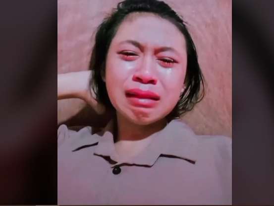 Takut Dimarahi Orang Tua, Cewek Ini Digigit King Kobra Hanya Diplaster, Kini Tubuhnya Membiru Lihat Potretnya!