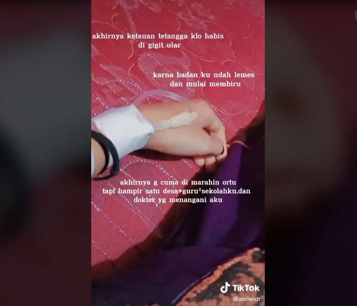 Takut Dimarahi Orang Tua, Cewek Ini Digigit King Kobra Hanya Diplaster, Kini Tubuhnya Membiru Lihat Potretnya!