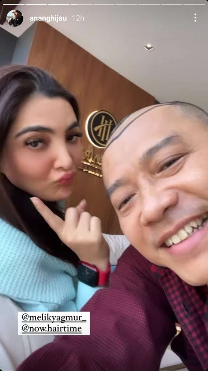 Potret Anang Hermansyah Pamer Kepala Botak Untuk Tanam Rambut, Deg-Degan Nunggu Hasilnya!