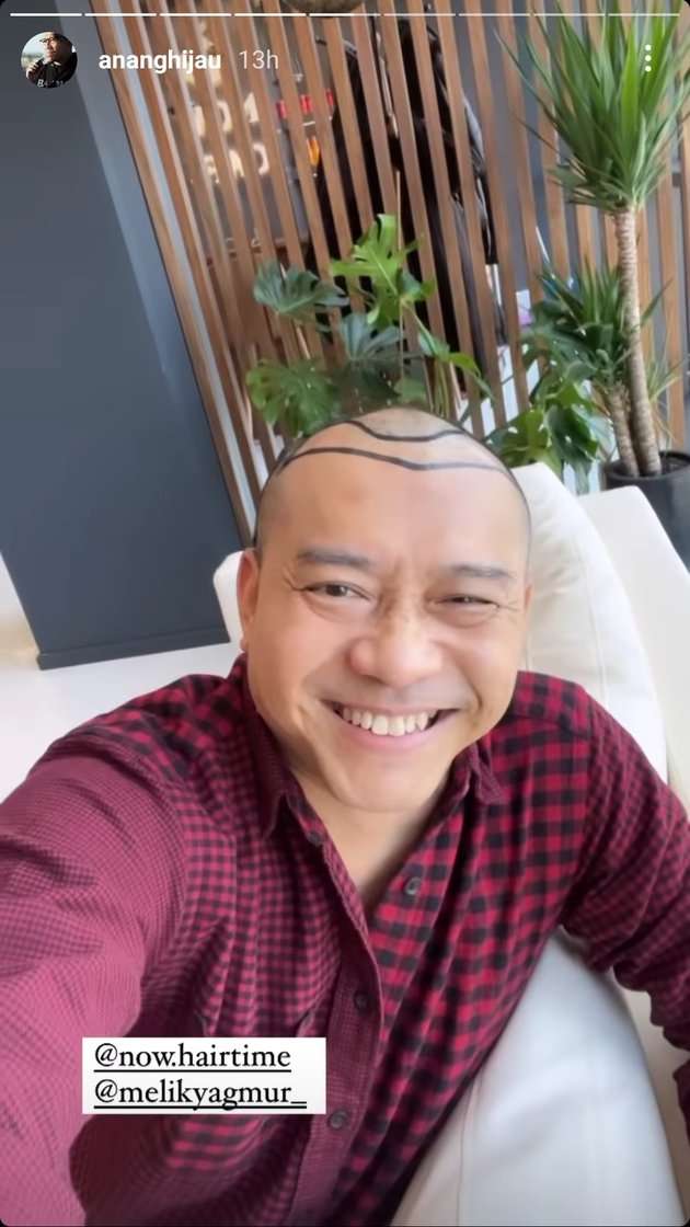 Potret Anang Hermansyah Pamer Kepala Botak Untuk Tanam Rambut, Deg-Degan Nunggu Hasilnya!