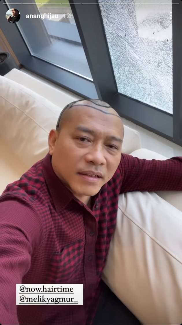 Potret Anang Hermansyah Pamer Kepala Botak Untuk Tanam Rambut, Deg-Degan Nunggu Hasilnya!