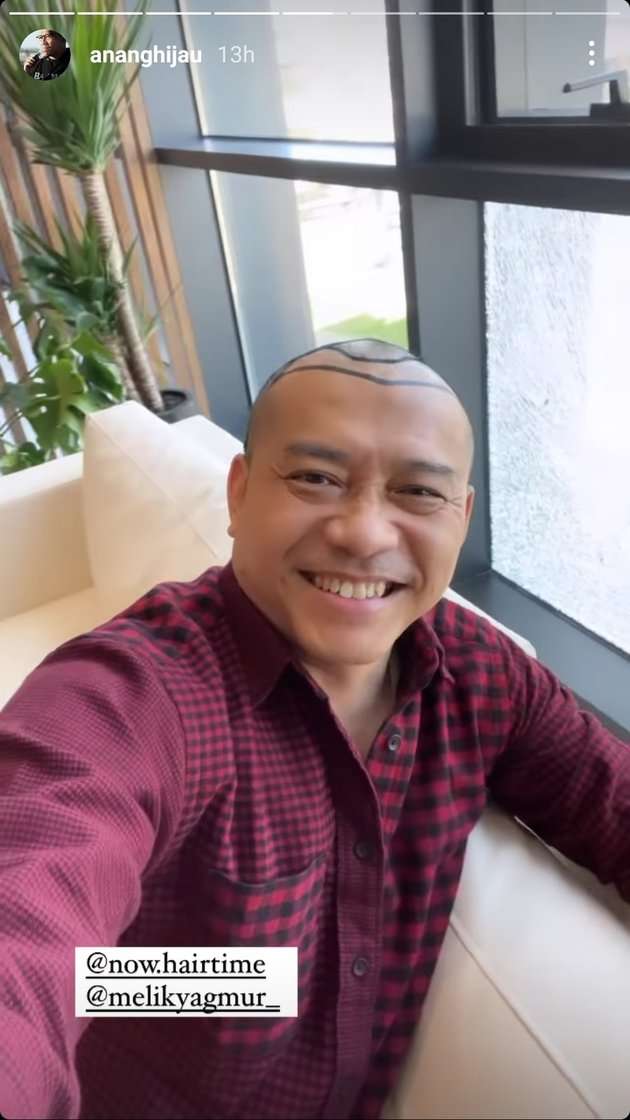 Potret Anang Hermansyah Pamer Kepala Botak Untuk Tanam Rambut, Deg-Degan Nunggu Hasilnya!