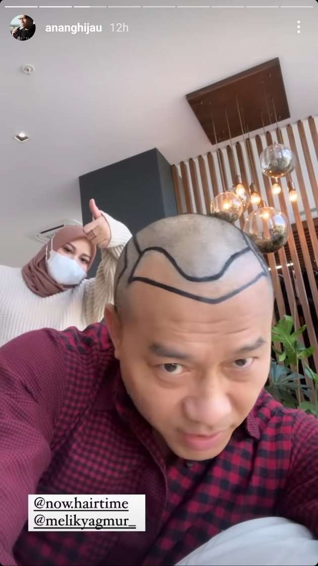 Potret Anang Hermansyah Pamer Kepala Botak Untuk Tanam Rambut, Deg-Degan Nunggu Hasilnya!