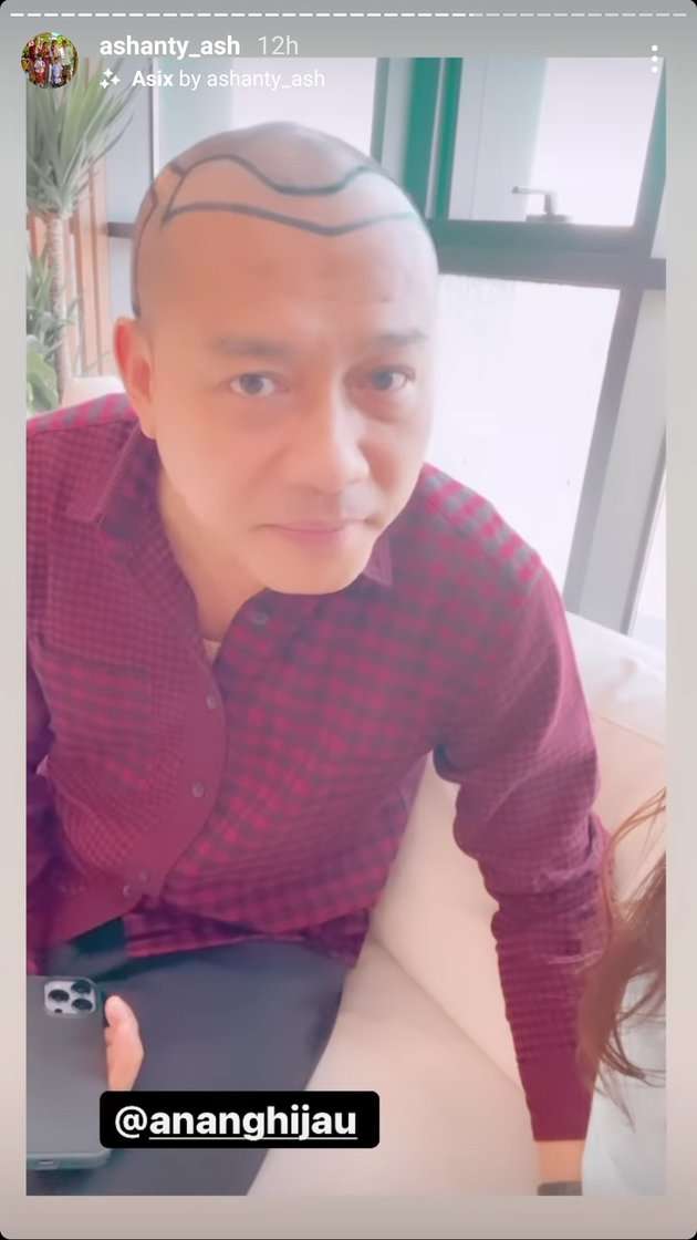 Potret Anang Hermansyah Pamer Kepala Botak Untuk Tanam Rambut, Deg-Degan Nunggu Hasilnya!