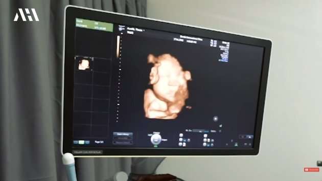 Diperkirakan Lahir di Tanggal Cantik Aurel Hermansyah Rutin Periksa Kandungan, Lihat 8 Potretnya!