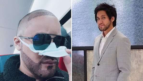 6 Potret Artis Sebelum Vs Sesudah Transplantasi Rambut, Atta Halilintar Makin Keren & Ganteng Abis!