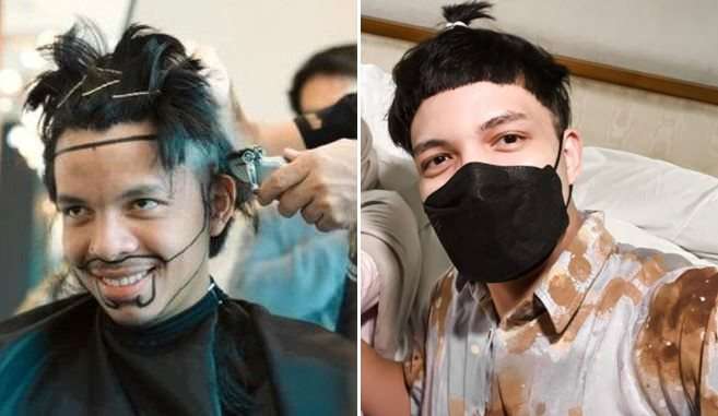 6 Potret Artis Sebelum Vs Sesudah Transplantasi Rambut, Atta Halilintar Makin Keren & Ganteng Abis!