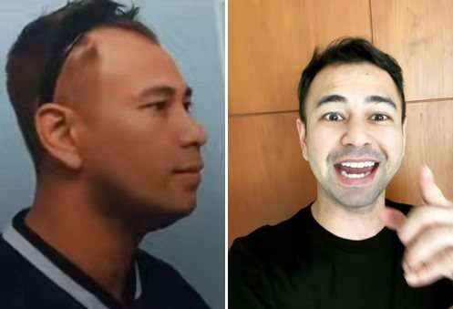 6 Potret Artis Sebelum Vs Sesudah Transplantasi Rambut, Atta Halilintar Makin Keren & Ganteng Abis!