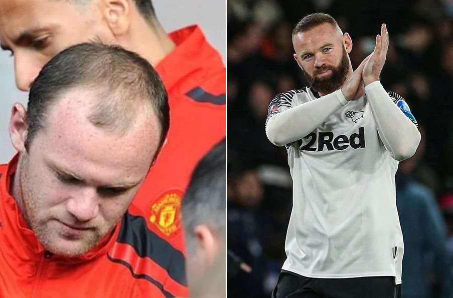 6 Potret Artis Sebelum Vs Sesudah Transplantasi Rambut, Atta Halilintar Makin Keren & Ganteng Abis!