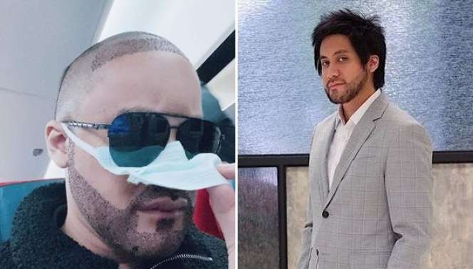 6 Potret Artis Sebelum Vs Sesudah Transplantasi Rambut, Atta Halilintar Makin Keren & Ganteng Abis!