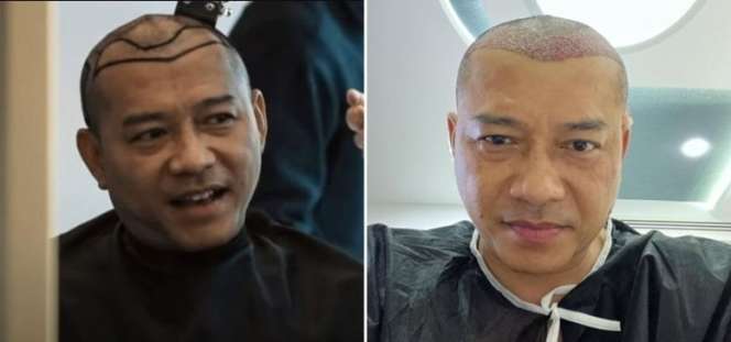 6 Potret Artis Sebelum Vs Sesudah Transplantasi Rambut, Atta Halilintar Makin Keren & Ganteng Abis!