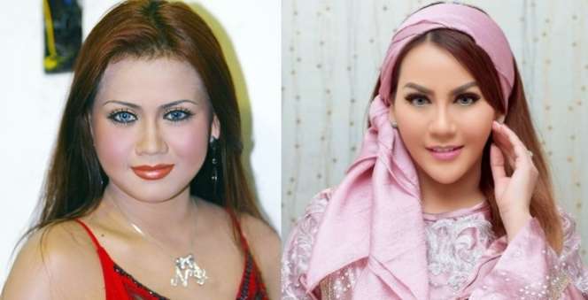 12 Potret Artis Sebelum Vs Sesudah Operasi Plastik, Dara Arafah Berubah Drastis!