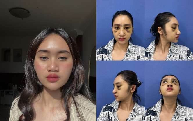 12 Potret Artis Sebelum Vs Sesudah Operasi Plastik, Dara Arafah Berubah Drastis!
