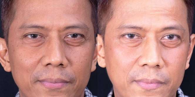 5 Potret Terbaru Doddy Sudrajat Berubah Jadi Glowing usai Jalani Perawatan Wajah, Habis Rp25 Juta!