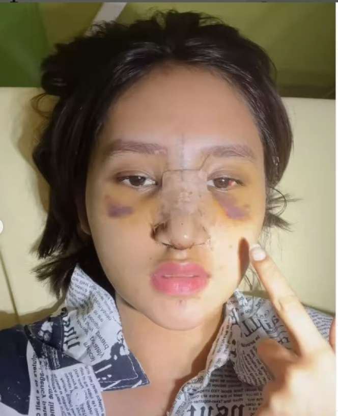 7 Potret Permesta Dhyaz Anak Farida Nurhan Usai Oplas Hidung, Parasnya Bikin Salfok!