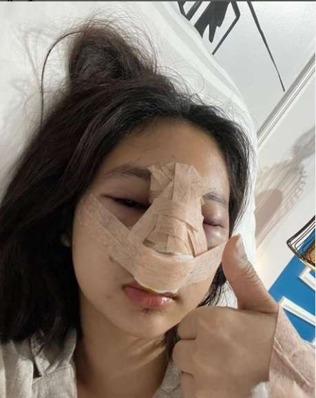 7 Potret Permesta Dhyaz Anak Farida Nurhan Usai Oplas Hidung, Parasnya Bikin Salfok!