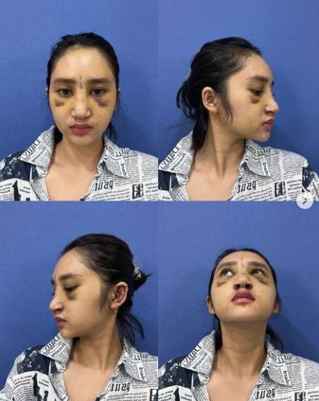 7 Potret Permesta Dhyaz Anak Farida Nurhan Usai Oplas Hidung, Parasnya Bikin Salfok!