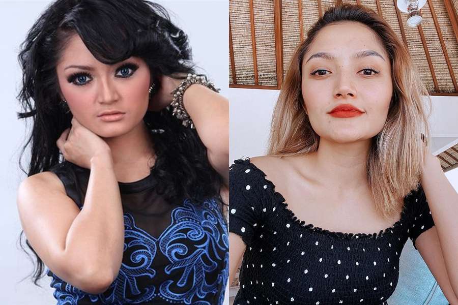 12 Potret Artis Sebelum Vs Sesudah Lakukan Filler Wajah, Cimoy Montok Jadi Beda Banget!