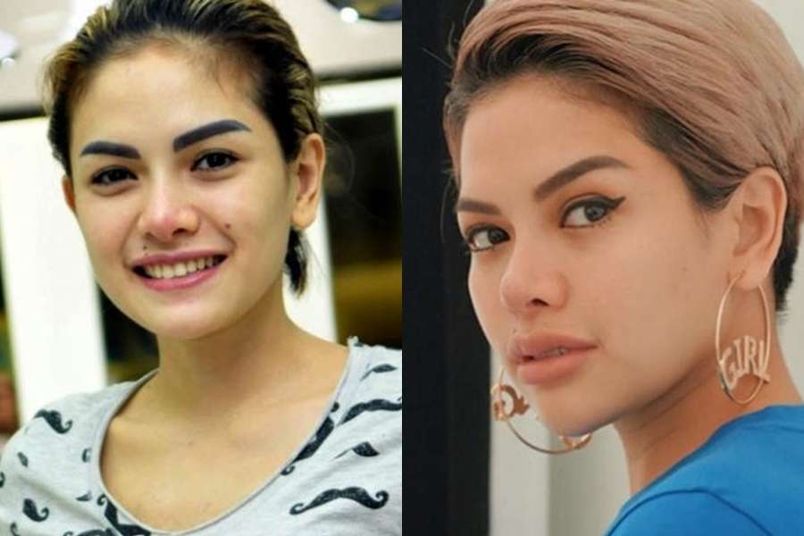 12 Potret Artis Sebelum Vs Sesudah Lakukan Filler Wajah, Cimoy Montok Jadi Beda Banget!