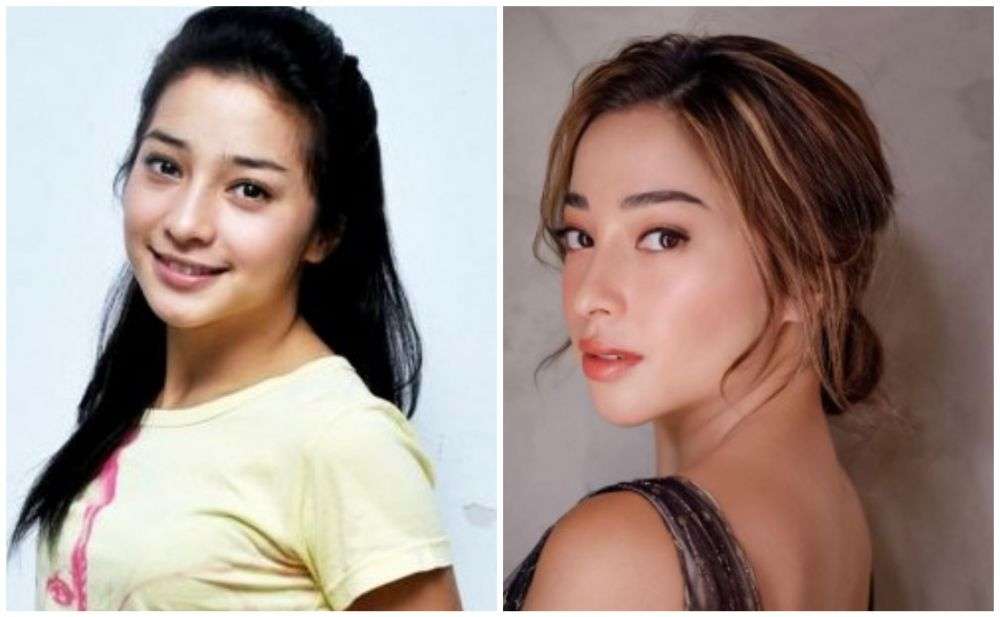 12 Potret Artis Sebelum Vs Sesudah Lakukan Filler Wajah, Cimoy Montok Jadi Beda Banget!