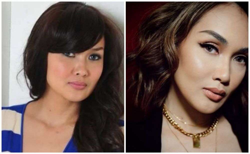 12 Potret Artis Sebelum Vs Sesudah Lakukan Filler Wajah, Cimoy Montok Jadi Beda Banget!