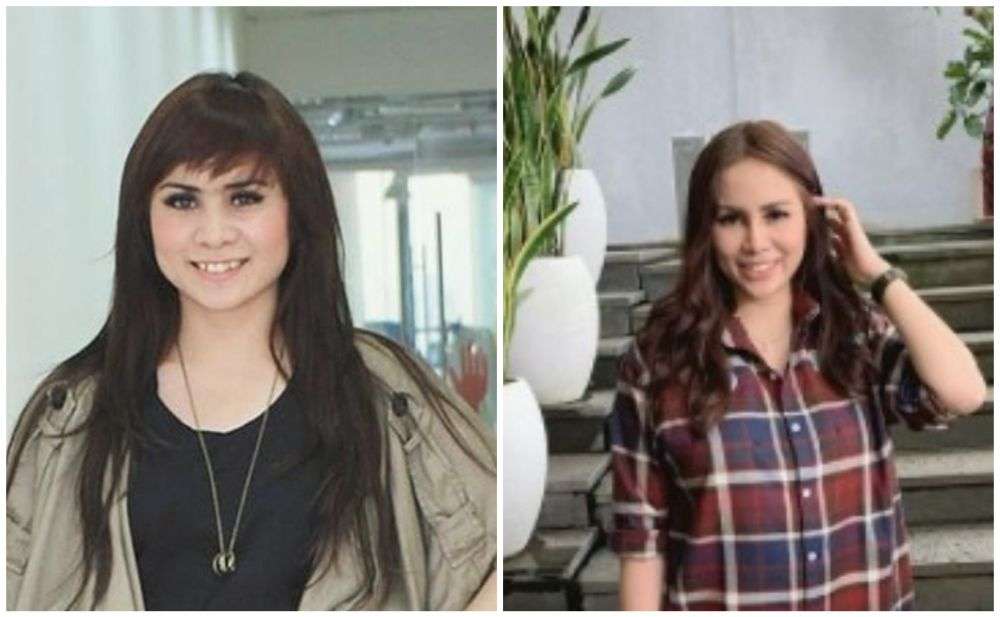 12 Potret Artis Sebelum Vs Sesudah Lakukan Filler Wajah, Cimoy Montok Jadi Beda Banget!