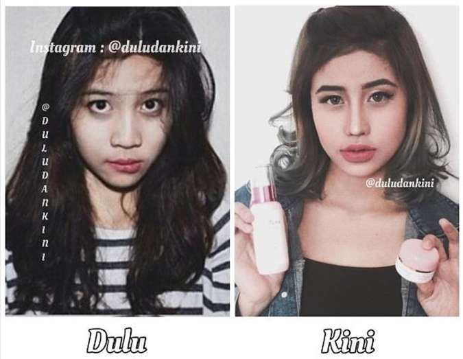 12 Potret Artis Sebelum Vs Sesudah Lakukan Filler Wajah, Cimoy Montok Jadi Beda Banget!