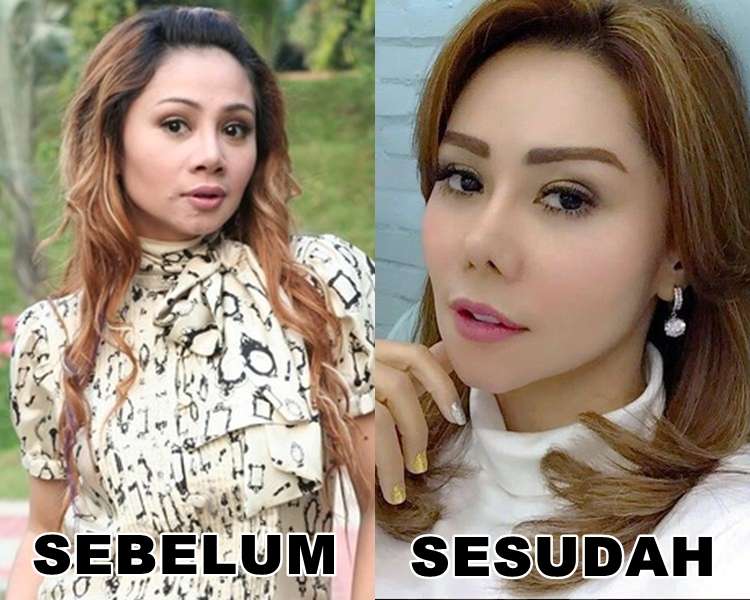 12 Potret Artis Sebelum Vs Sesudah Lakukan Filler Wajah, Cimoy Montok Jadi Beda Banget!