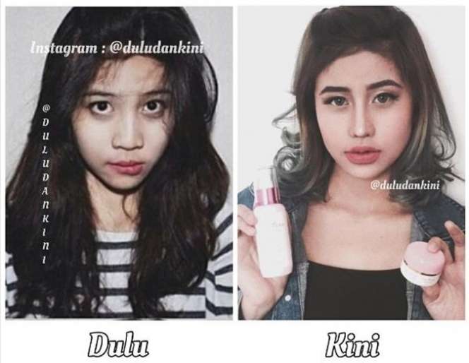 12 Potret Artis Sebelum Vs Sesudah Lakukan Filler Wajah, Cimoy Montok Jadi Beda Banget!