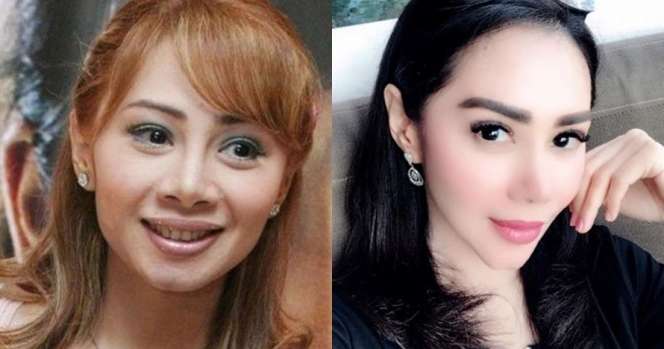 Potret 10 Seleb Usai Operasi Hidung, Ada yang Alami Implan Jebol Hingga Bernanah!