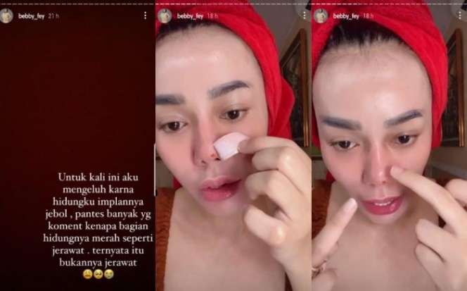 Potret 10 Seleb Usai Operasi Hidung, Ada yang Alami Implan Jebol Hingga Bernanah!
