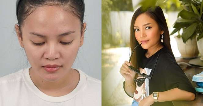 Potret 10 Seleb Usai Operasi Hidung, Ada yang Alami Implan Jebol Hingga Bernanah!
