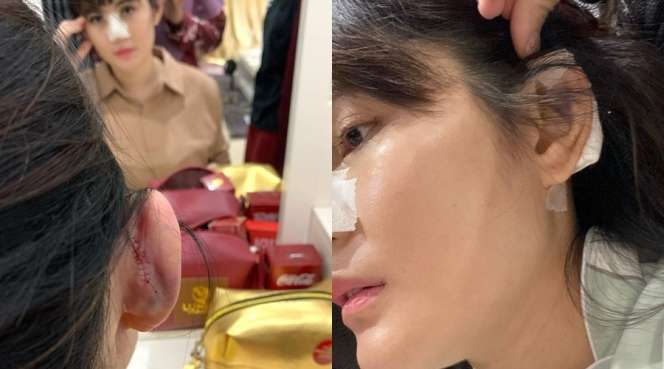 Potret 10 Seleb Usai Operasi Hidung, Ada yang Alami Implan Jebol Hingga Bernanah!
