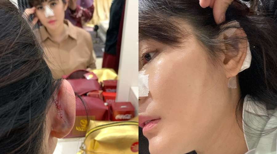 Potret 10 Seleb Usai Operasi Hidung, Ada yang Alami Implan Jebol Hingga Bernanah!