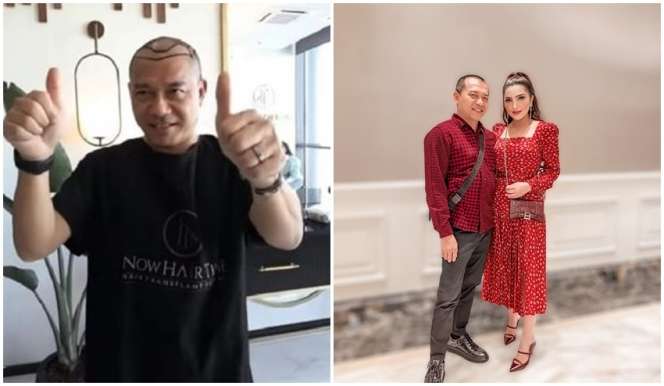 8 Potret Sebelum dan Sesudah Anang Hermansyah Lakukan Transplantasi Rambut, Terlihat Lebih Muda!