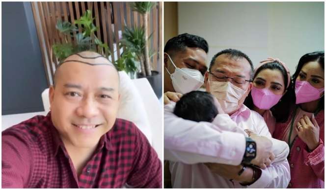 8 Potret Sebelum dan Sesudah Anang Hermansyah Lakukan Transplantasi Rambut, Terlihat Lebih Muda!