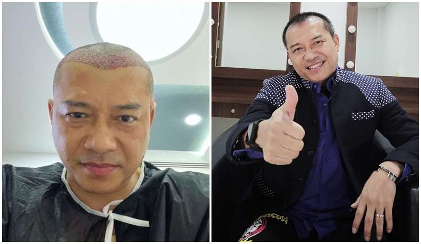 8 Potret Sebelum dan Sesudah Anang Hermansyah Lakukan Transplantasi Rambut, Terlihat Lebih Muda!