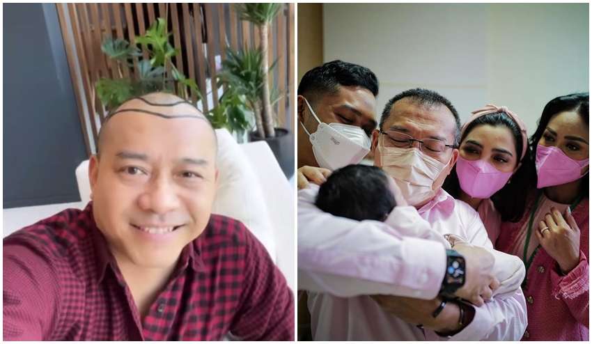 8 Potret Sebelum dan Sesudah Anang Hermansyah Lakukan Transplantasi Rambut, Terlihat Lebih Muda!