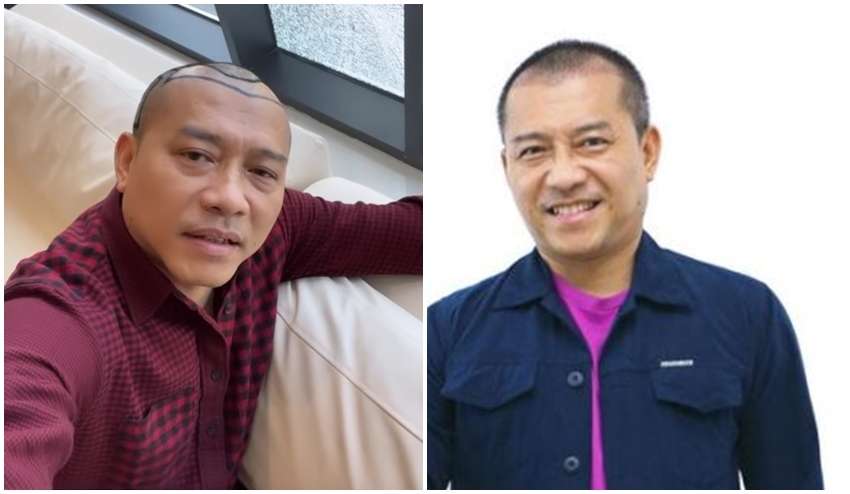 8 Potret Sebelum dan Sesudah Anang Hermansyah Lakukan Transplantasi Rambut, Terlihat Lebih Muda!