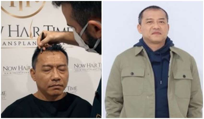 8 Potret Sebelum dan Sesudah Anang Hermansyah Lakukan Transplantasi Rambut, Terlihat Lebih Muda!