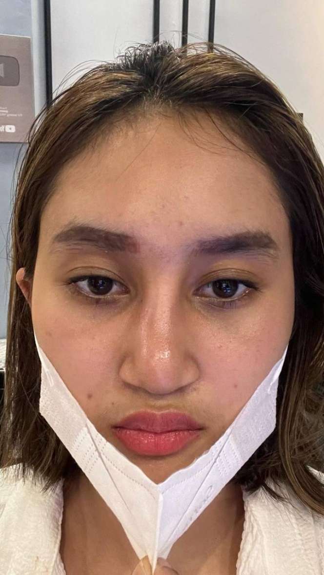 5 Potret Permesta Dhyaz Anak Farida Nurhan Alami Infeksi Hidung Pasca Oplas