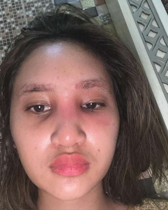 5 Potret Permesta Dhyaz Anak Farida Nurhan Alami Infeksi Hidung Pasca Oplas