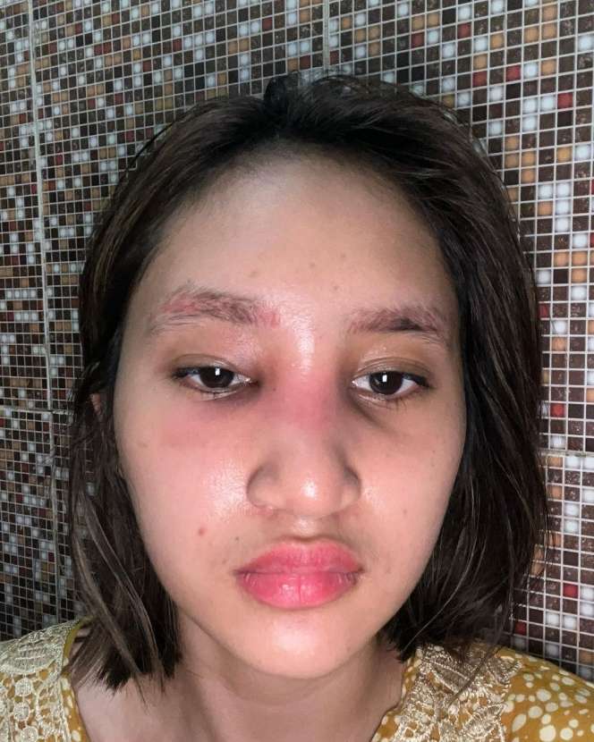 5 Potret Permesta Dhyaz Anak Farida Nurhan Alami Infeksi Hidung Pasca Oplas