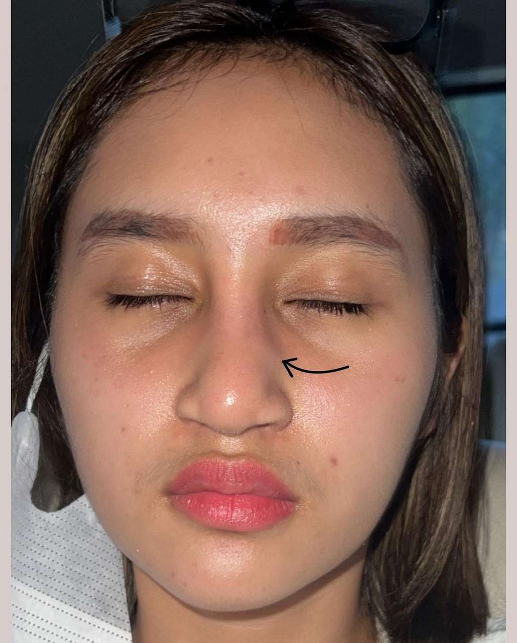 5 Potret Permesta Dhyaz Anak Farida Nurhan Alami Infeksi Hidung Pasca Oplas