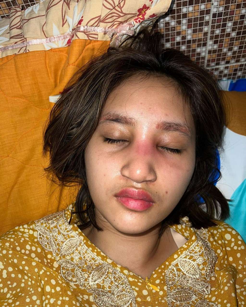 5 Potret Permesta Dhyaz Anak Farida Nurhan Alami Infeksi Hidung Pasca Oplas