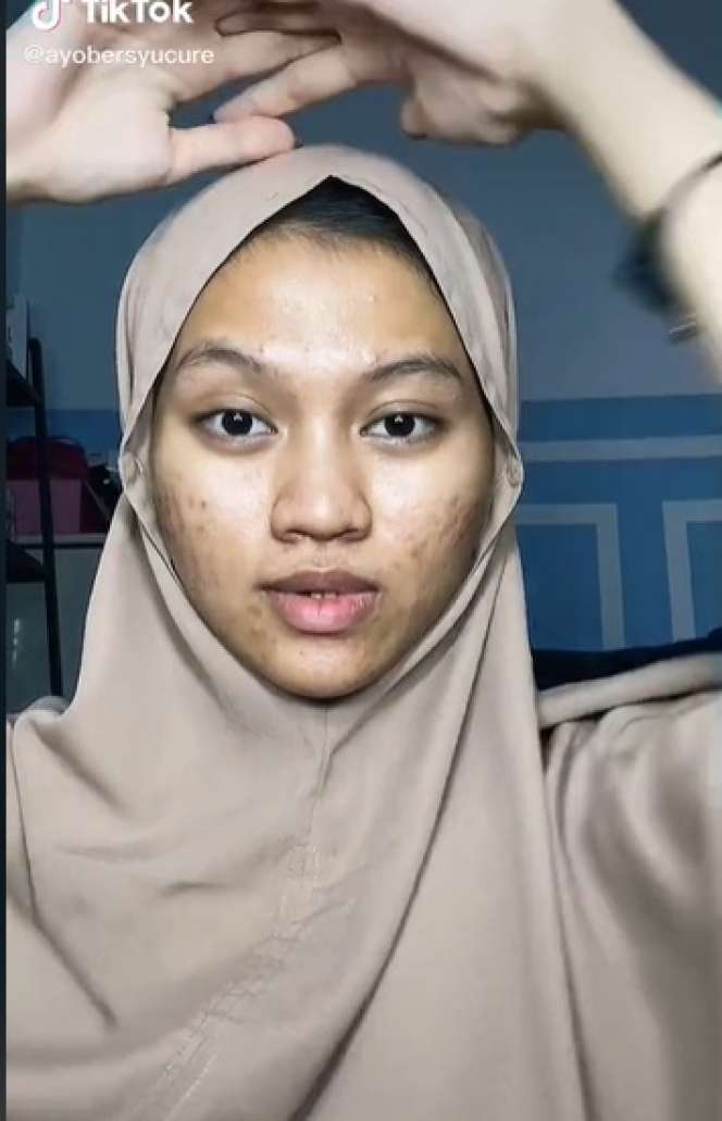 Potret Sebelum dan Sesudah Wanita Berjerawat Dimakeup, Hasilnya Bikin Tercengang!