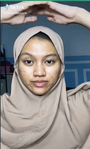 Potret Sebelum dan Sesudah Wanita Berjerawat Dimakeup, Hasilnya Bikin Tercengang!