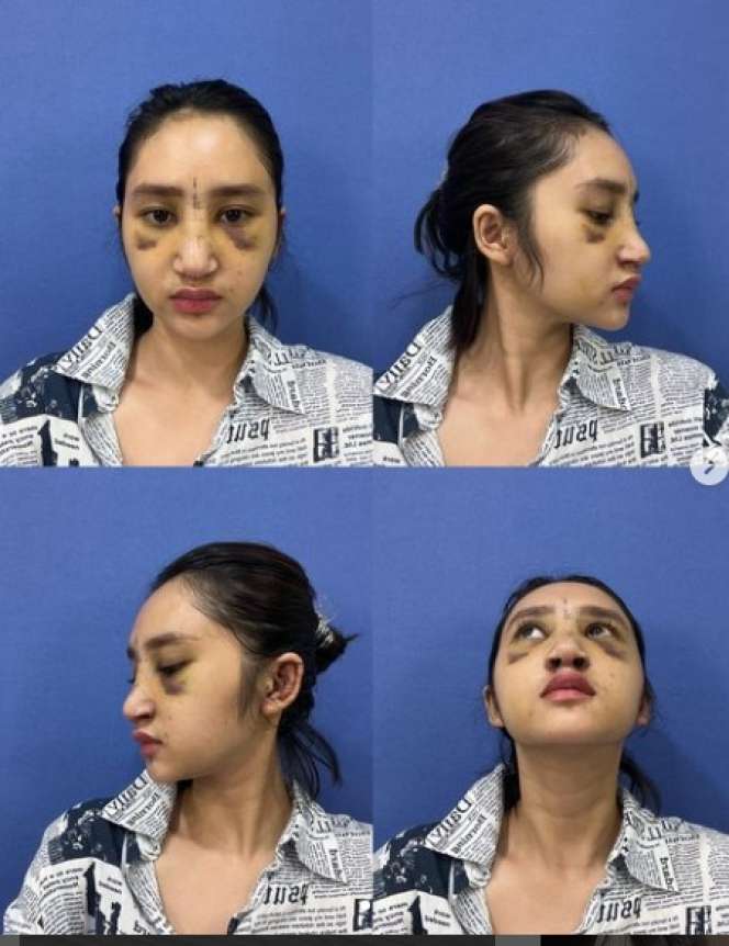 Potret Gaya Permesta Dhyaz Anak Farida Nurhan, Pernah Oplas di Thailand Hingga Hidungnya Alami Infeksi!