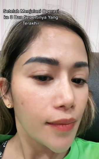 3 Kali Operasi Plastik, Bentuk Hidung Terbaru Farida Nurhan Jadi Sorotan